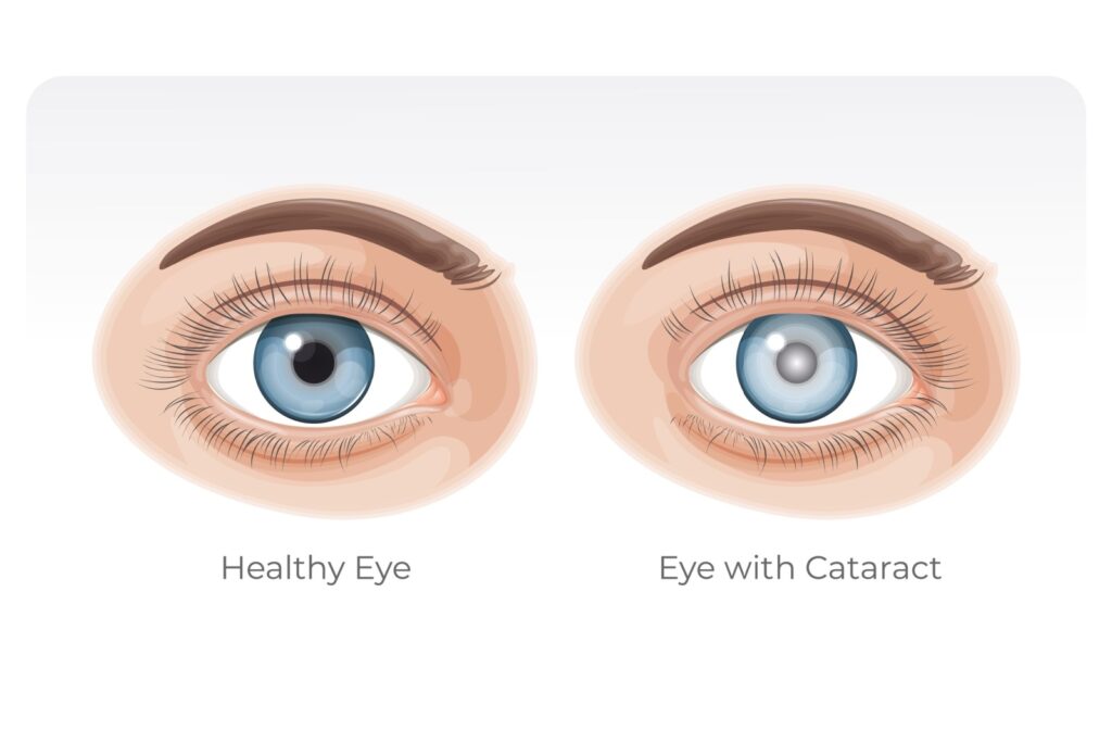 Side by side illustrated comparison of a healthy eye vs an eye with cataract