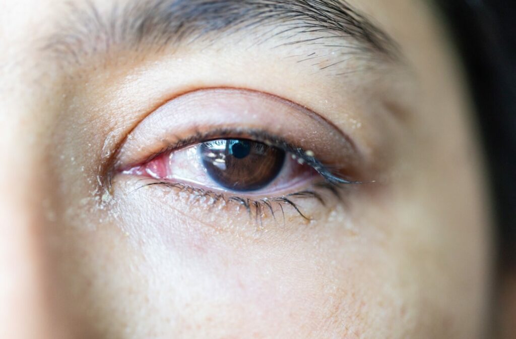 Close-up of an excessively water eye.