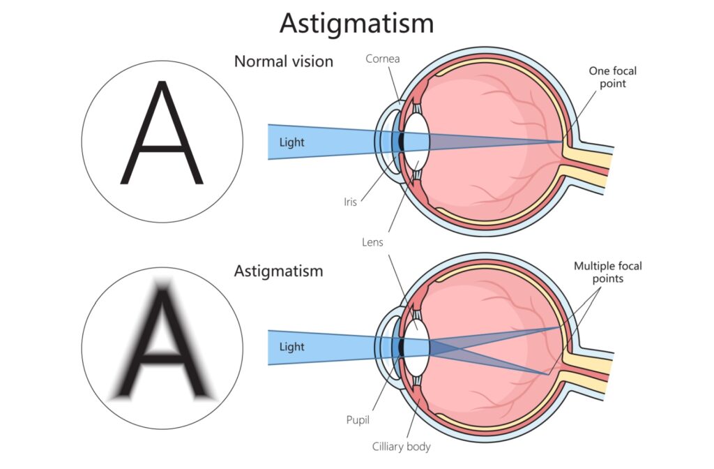Diagram showing normal vision compared to astigmatism. Normal vision has one focal point on the retina, while astigmatism’s irregular cornea shape creates multiple focal points, causing blurry or distorted vision at all distances.