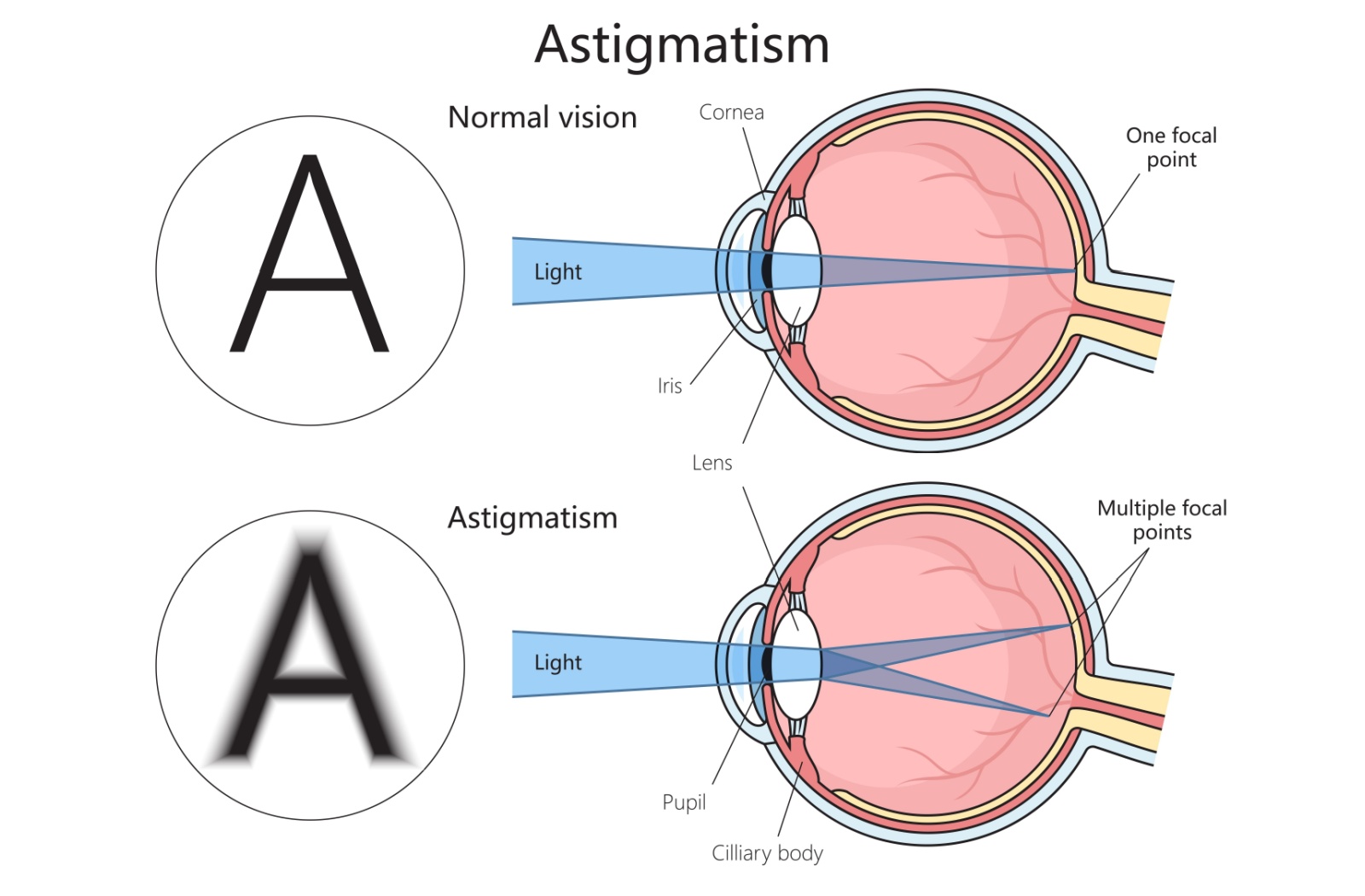Astigmatism vs. Myopia: What's the Difference?