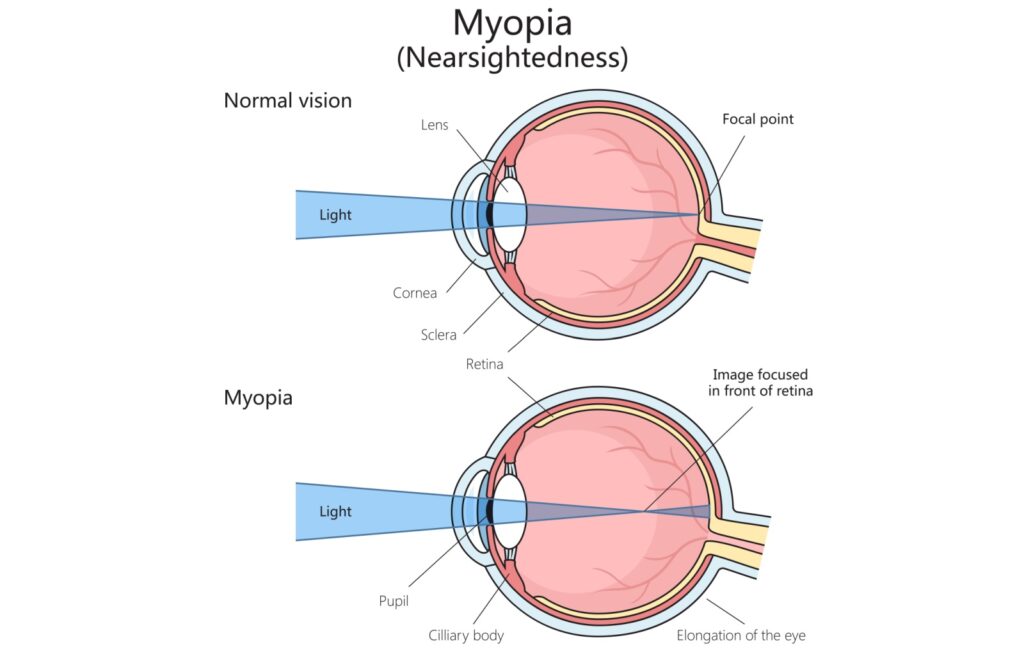 Diagram comparing normal vision and myopia. In normal vision, light focuses directly on the retina. In myopia, the elongated eyeball causes light to focus in front of the retina, making distant objects appear blurry.