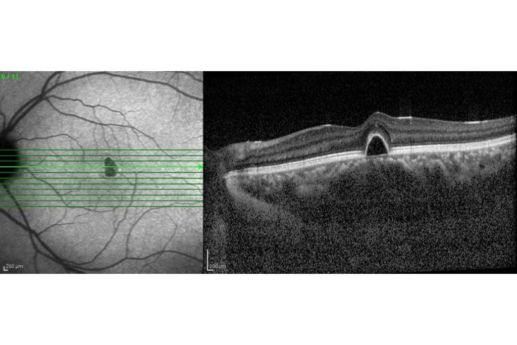 Optical coherence tomography scan showing a cross-section of the retina and macula with visible retinal layers for diagnostic evaluation.