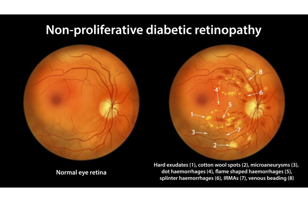 Retinal images showing non-proliferative diabetic retinopathy with hemorrhages.