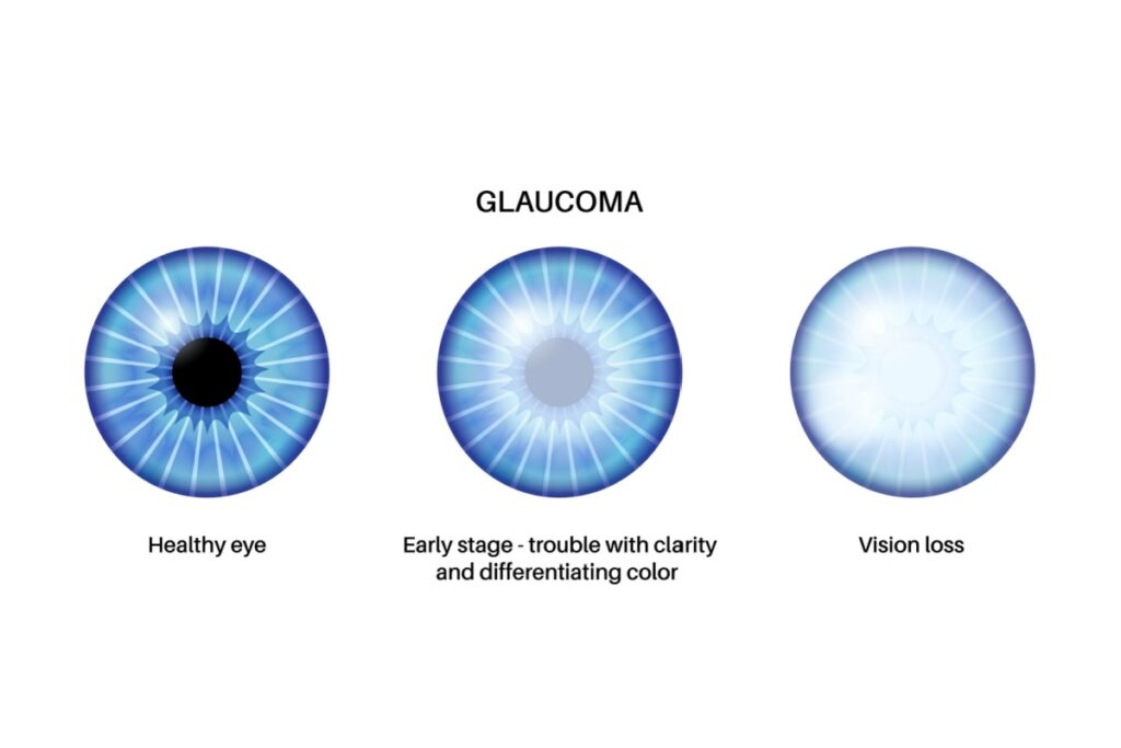 Visual comparison of glaucoma progression showing healthy eye with clear vision, early stage with blurred clarity and color differentiation issues, and advanced stage with severe vision loss.
