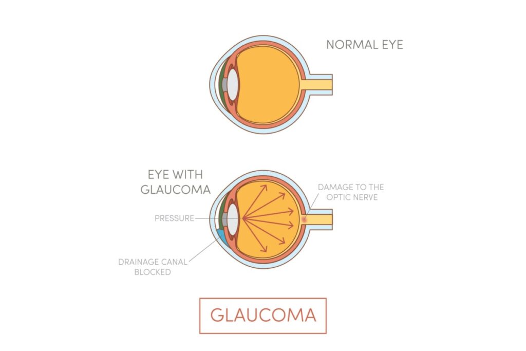 Anatomical diagram showing normal eye compared to eye with glaucoma, illustrating blocked drainage canal, increased intraocular pressure, and optic nerve damage.