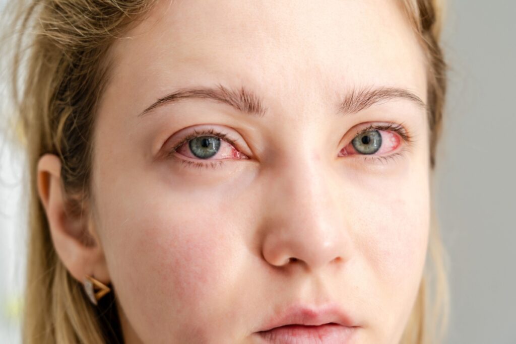 Close up of woman with irritated red eyes.